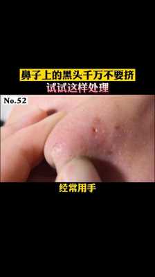 鼻头黑头怎么去除,鼻头很多黑头怎么办图片