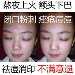 脸上长粉刺痘痘要怎么处理,脸上长粉刺了怎么办怎么去了