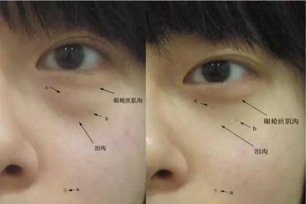 眼袋怎么形成的,眼袋是什么形成的图片