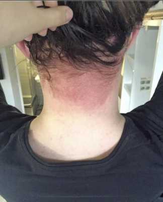 染发剂过敏了怎么办（网上买的染发剂过敏了怎么赔偿）