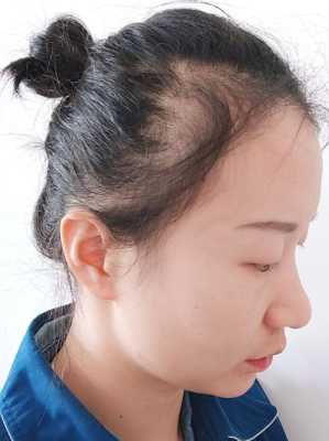 头发稀疏怎么（12岁发量就很少怎么办）