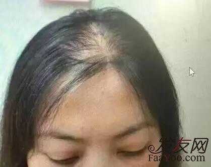 女性为什么会脱发（女性为什么会脱发严重）