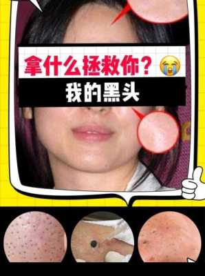 大黑头怎么办（收缩毛孔粗大黑头怎么办）