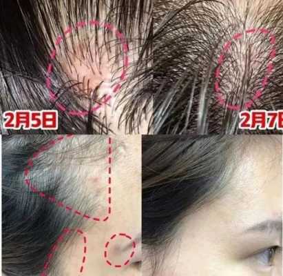 头皮总是出油厉害是怎么回事?头皮出油怎么办,头皮爱出油是什么原因引起的