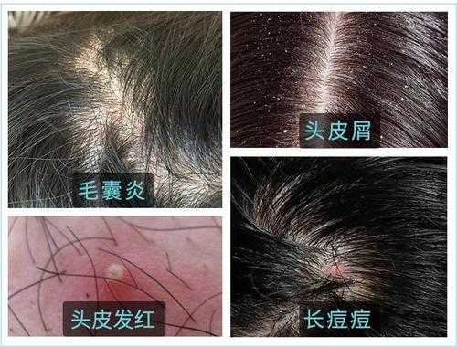 头皮总是出油厉害是怎么回事?头皮出油怎么办,头皮爱出油是什么原因引起的