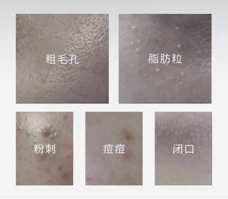 白头粉刺怎么彻底去除（白头粉刺怎么彻底去除视频）