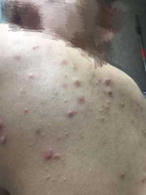 背上有很多痘痘怎么办（背上有很多痘痘怎么办还很痒）
