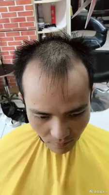 额头两边窄适合什么发型（两边额头比较秃什么发型好看）