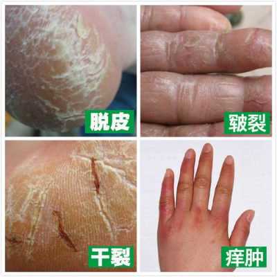 脚干裂脱皮怎么办,下巴皮肤干裂脱皮怎么办
