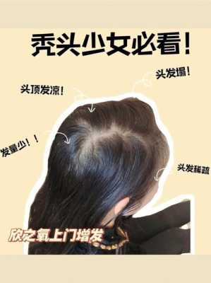 天生发量少，怎么增多,天生发量少怎么办如何增加发量