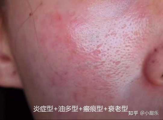 脸上毛孔粗大是怎么回事（什么是毛孔粗大和闭口）