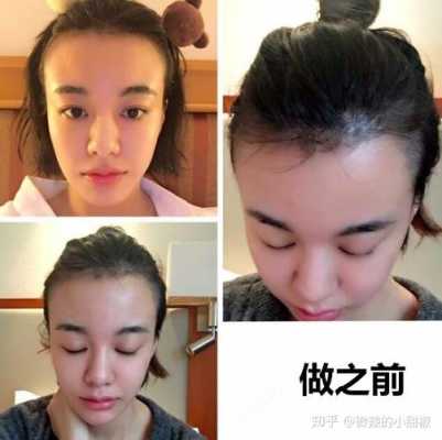 发际高怎么办（发际线好高怎么办）