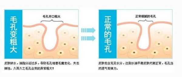 脸部毛孔堵塞怎么疏通（毛孔变成洞怎么处理）