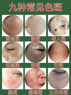 怎么祛斑美容（淡斑消斑的方法有几种）