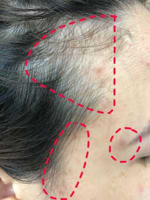 为什么我的头发总是塌在额头上,脑门掉头发是什么原因造成的