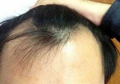 为什么我的头发总是塌在额头上,脑门掉头发是什么原因造成的