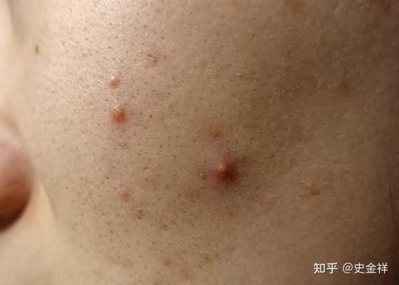 脸上的毛孔大怎么办（脸上的毛孔大怎么办呢视频）