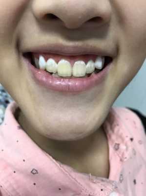 牙齿越来越黄怎么回事（牙齿表面的黄色怎么去掉）