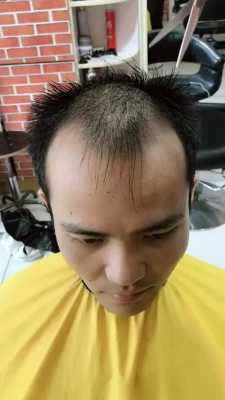 头顶有点秃剪什么发型,头顶有点脱发怎么办啊
