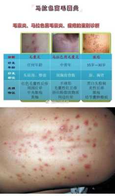 上背长痘痘是什么原因（后背起痘痘什么原因）