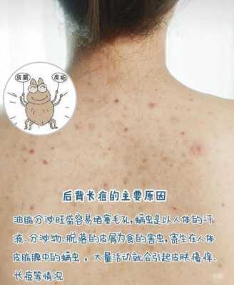 上背长痘痘是什么原因（后背起痘痘什么原因）