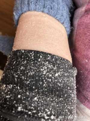 干皮冬天起皮怎么办,皮肤冬天起皮怎么办