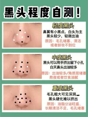 鼻头黑头怎么去除,鼻头黑头怎么去除最有效小妙招