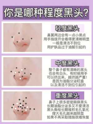 鼻子上的黑头怎么消除（去黑头的简单方法）