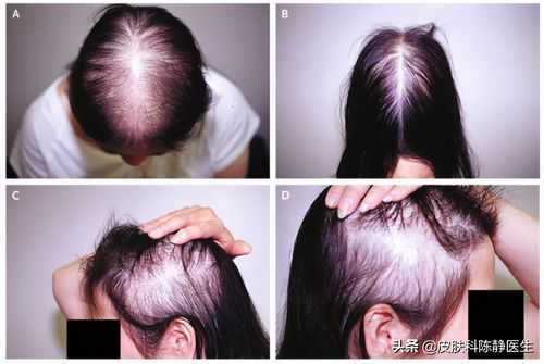 女人脱发严重是怎么回事,女生为什么脱发严重怎么办