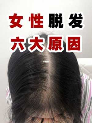 女人脱发严重是怎么回事,女生为什么脱发严重怎么办