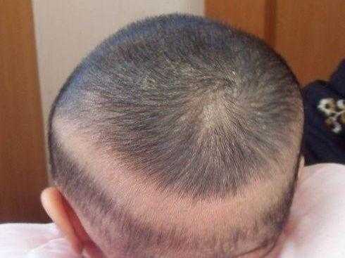 头发多怎么回事（为什么头顶的头发没有后脑勺多）