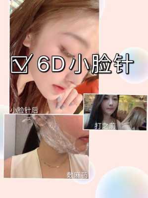 小脸是什么,什么是小脸针
