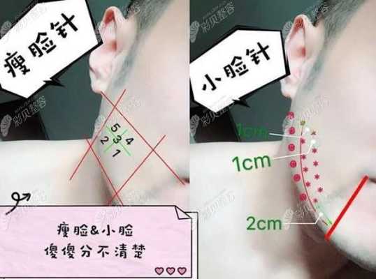 小脸是什么,什么是小脸针