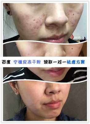 脸上的痘印怎么祛除最快最好,怎么消痘印最快最有效的方法