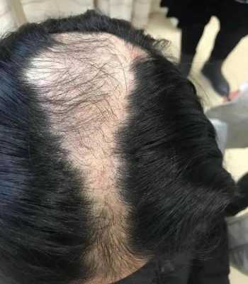 秃顶是为什么（秃顶是为什么引起的）