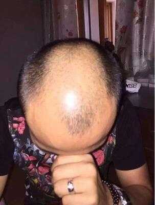 秃顶是为什么（秃顶是为什么引起的）