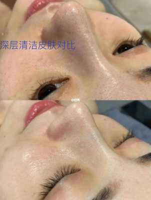 皮肤毛孔堵塞怎么清理（头皮毛囊堵塞怎么清洗）