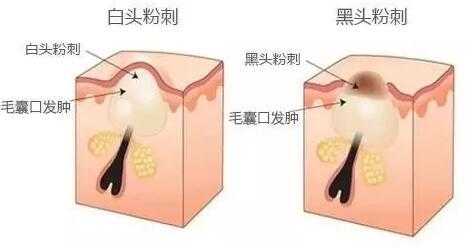 怎么去除脸上粉刺（怎么去除脸上粉刺黑头）