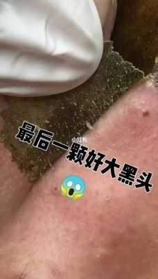 怎么去除脸上粉刺（怎么去除脸上粉刺黑头）