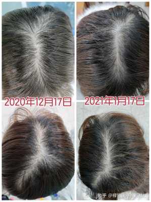 脱发是什么原因呢（脱发的原因，脱发的治疗方法有哪些）