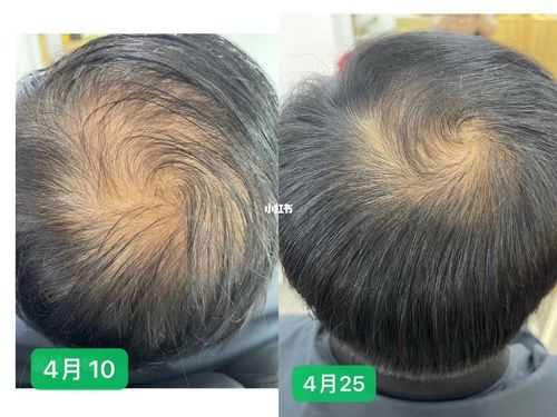 如何判断头发是否有脱发的现象,怎么判断自己是不是脱发症状