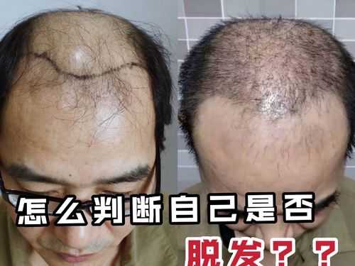 如何判断头发是否有脱发的现象,怎么判断自己是不是脱发症状