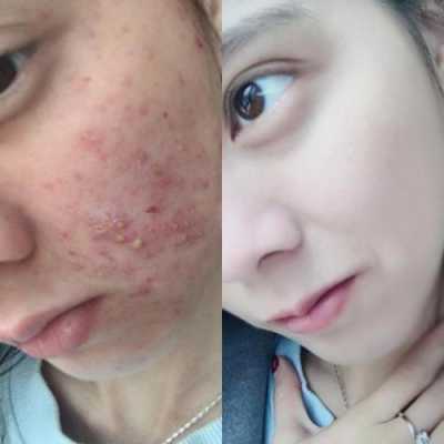 脸上长痘痘怎么快速去除,脸上长痘痘怎么快速去除?
