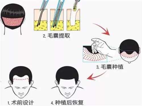 植发有什么要求（植发有什么要求）