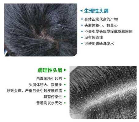 染发后头皮屑多怎么解决,染发后头皮屑多怎么办小妙招