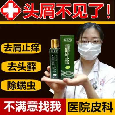 怎么去头屑最有效,用什么去头皮屑最有效的土方
