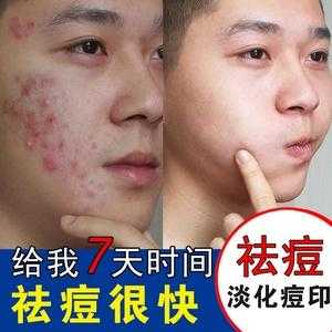 男士怎么祛痘（男士怎么祛痘印）