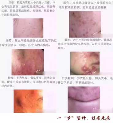 长粉刺怎么调理（长粉刺怎么调理身体）