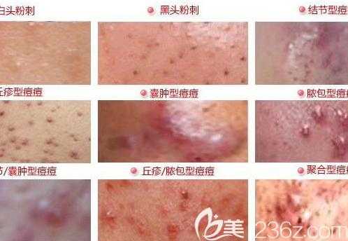 长粉刺怎么调理（长粉刺怎么调理身体）