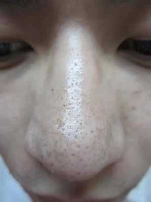 黑头什么样的（黑头什么样的图片）